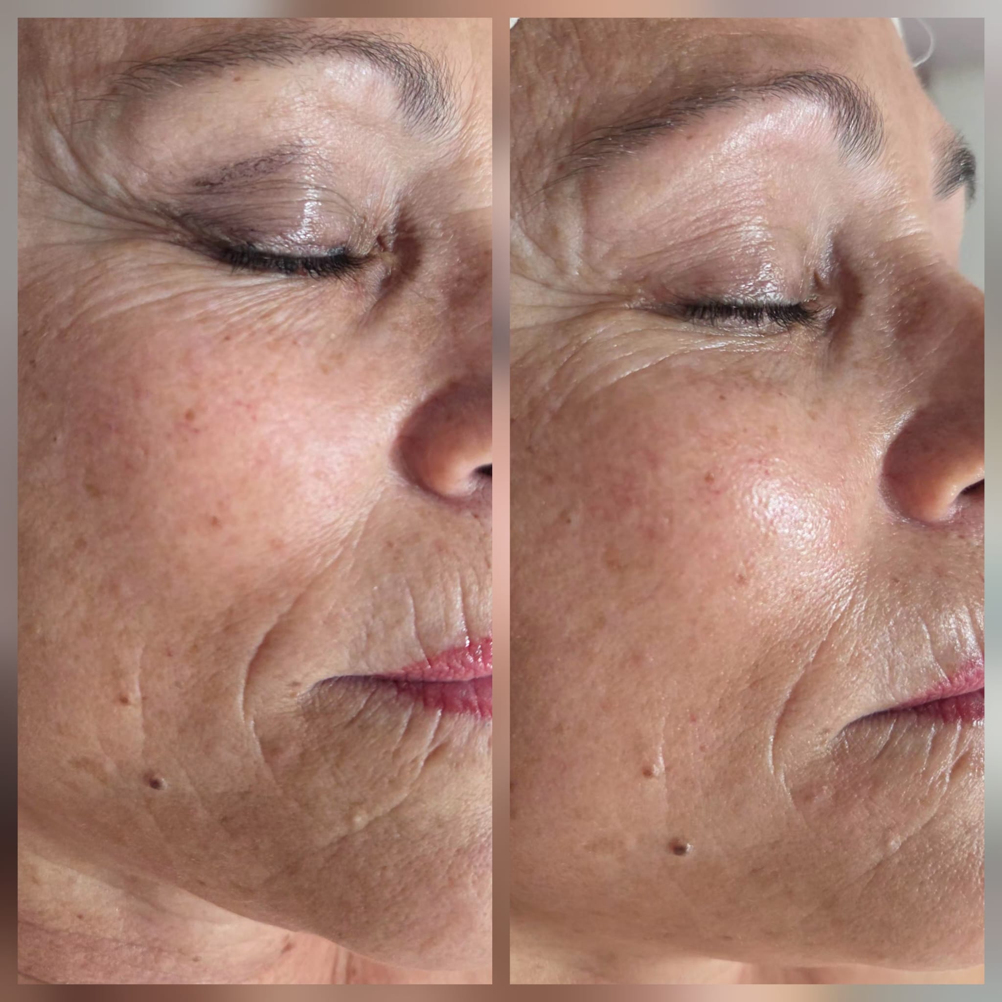 Resultados de rejuvenecimiento facial profesional